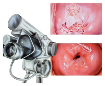 imagen de colposcopio y cuello del utero