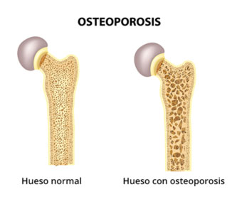 imagen de hueso normal y hueso con osteoporosis