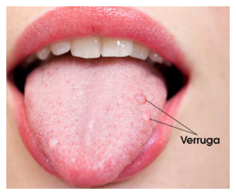 Verruga genital en lengua