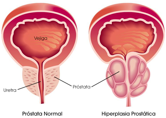 hiperplasia de prostata