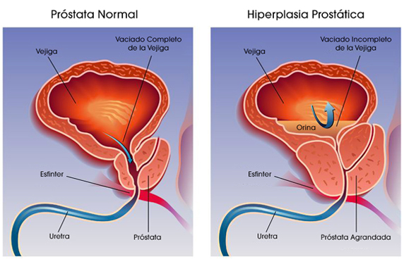 agrandamiento o hiperplasia de la prostata