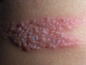 salpullido de herpes zoster 