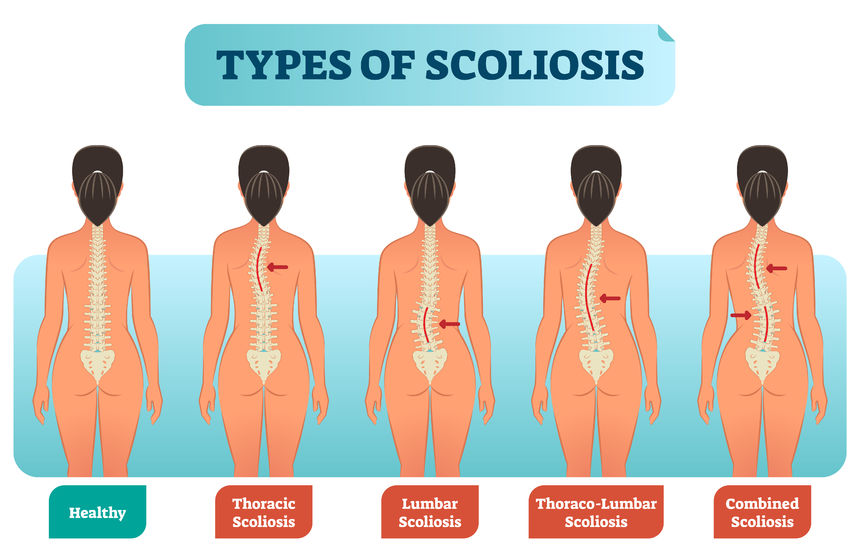 diagrama escoliosis