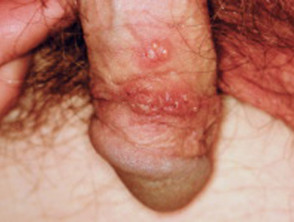foto de hombre con herpes genital