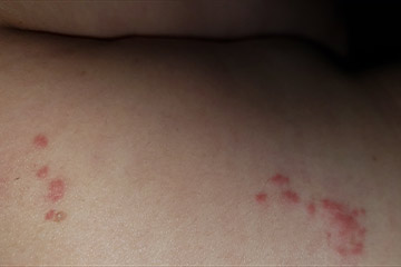 mujer con herpes zoster