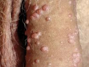 el papiloma humano en hombres