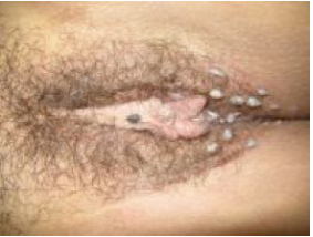 tipos de verrugas genitales fotos