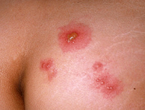 mujer con herpes genital