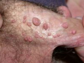 Como se cura el papiloma humano en hombres medical interview how would you change healthcare