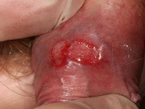 herpes genital en hombres