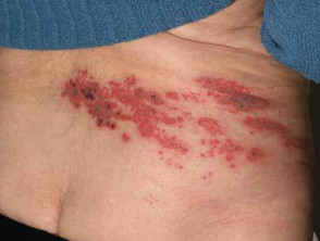 herpes zoster rash