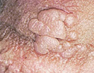foto de una verruga genital por VPH
