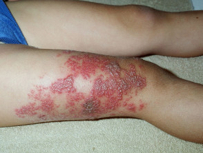 herpes zoster en la pierna