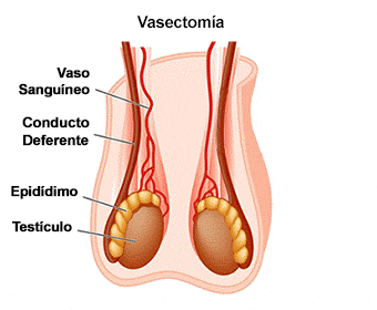esquema de como hacer la vasectomia