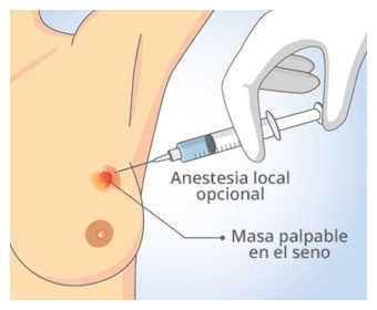 biopsia de seno con aguja fina