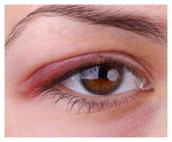 ojo con inflamación del párpado o blefaritis