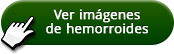 boton para imagenes de hemorroides