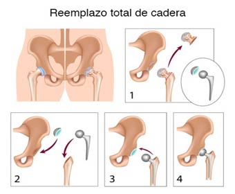 Reemplazo total de cadera