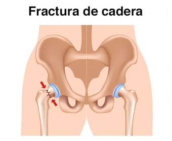 Fractura de cadera