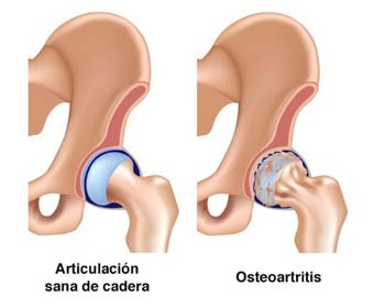 Osteoartritis