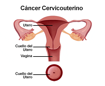 Animación de la evolución del cáncer cervicouterino