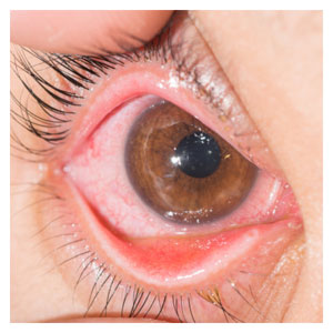 ojo rojo con conjuntivitis