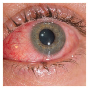 ojo rojo por conjuntivitis