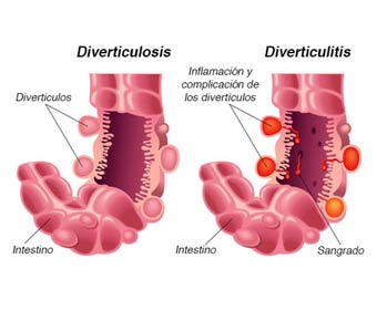 Diverticulitis