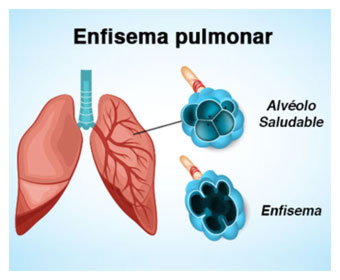 diagrama enfisema pulmonar