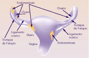 diagrama de endometriosis