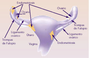 utero y endometriosis