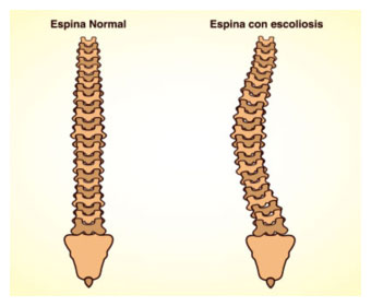 diagrama de escoliosis