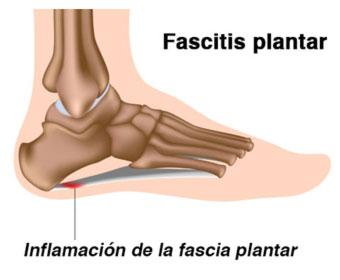 fascitis plantar