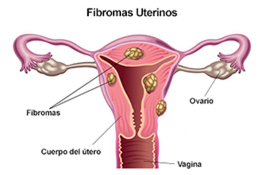 diagrama fibromas