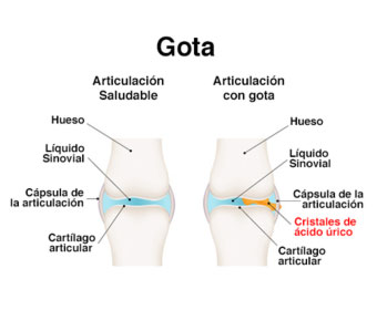 Esquema de rodilla afectada por la gota