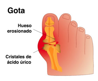 Esquema de pie afectado por la gota