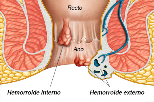 hemorroides en recto y ano