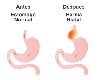 diagrama hernia hiatal