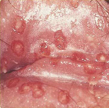 herpes simplex en una mujer