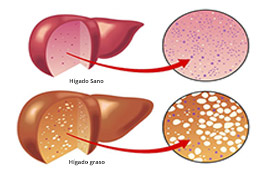 comparación hígado sano e hígado graso