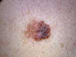 cancer de piel melanoma