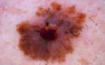 cancer de piel melanoma
