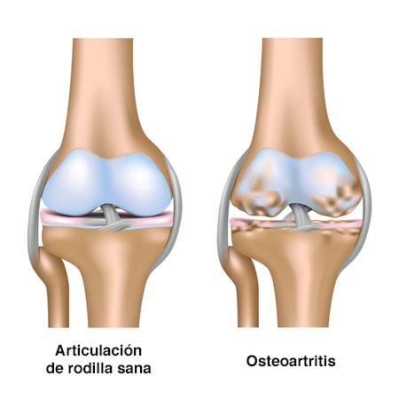 imagenes de rodilla con osteoartritis