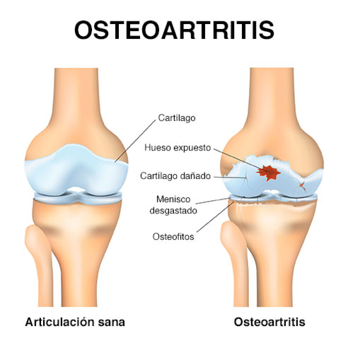 imagenes mostrando rodilla sana y rodilla con osteoartritis