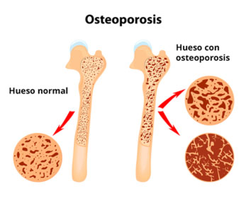 Imágenes de huesos con osteoporosis