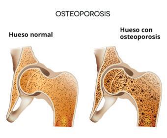 imagen de hueso normal y hueso con osteoporosis