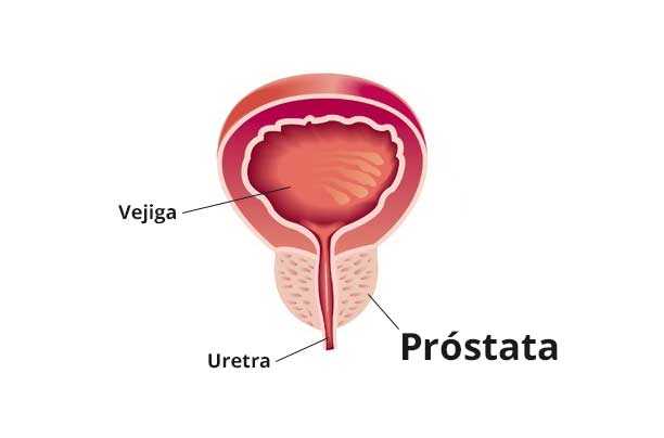 cancer de prostata