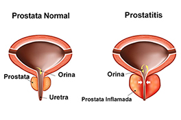 diagrama de prostatitis