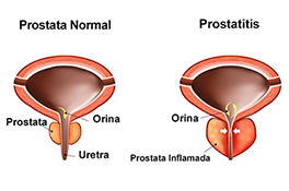 la prostatitis es grave)