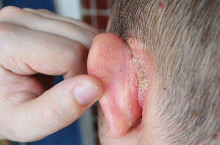 Psoriasis en la oreja
